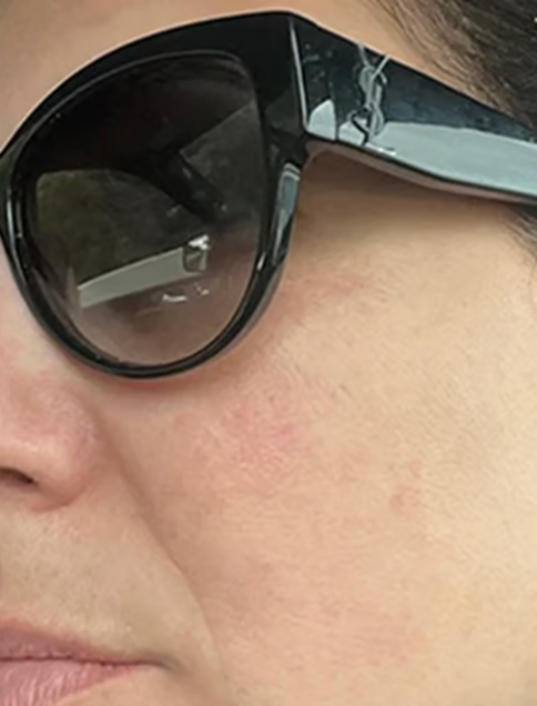 After — clearer skin after Sun Powder