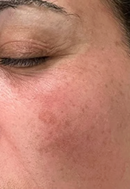 Before — sun damage and redness