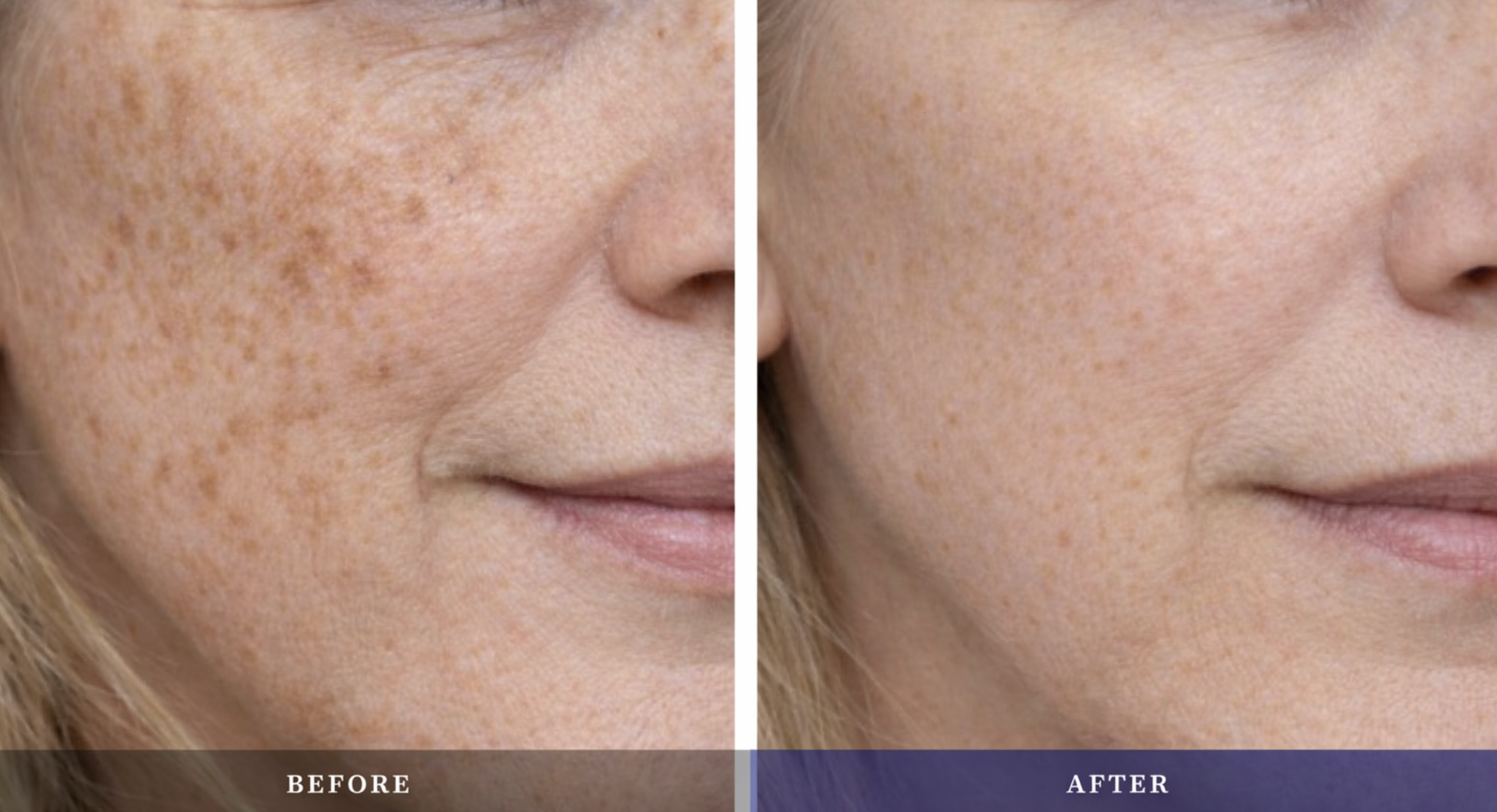 Before and after: fine lines and sun spots transformation