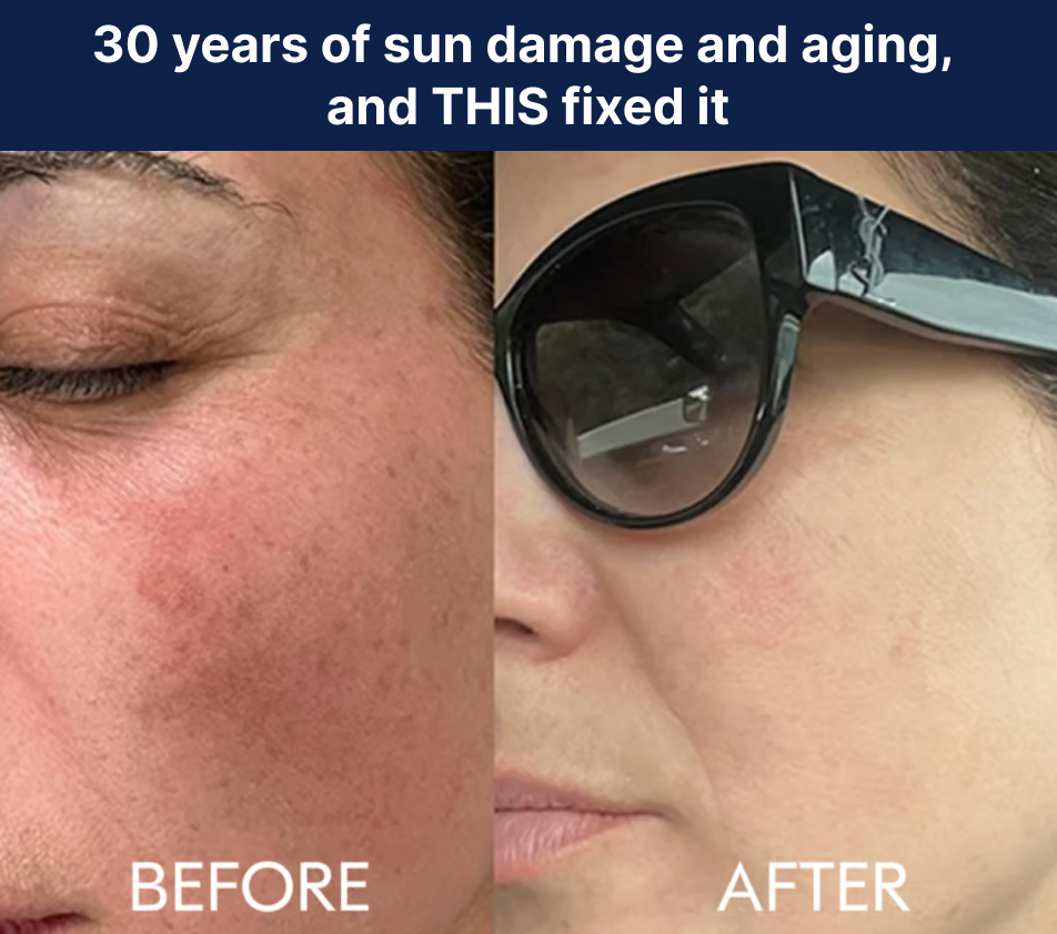Before and after 30 years of sun damage