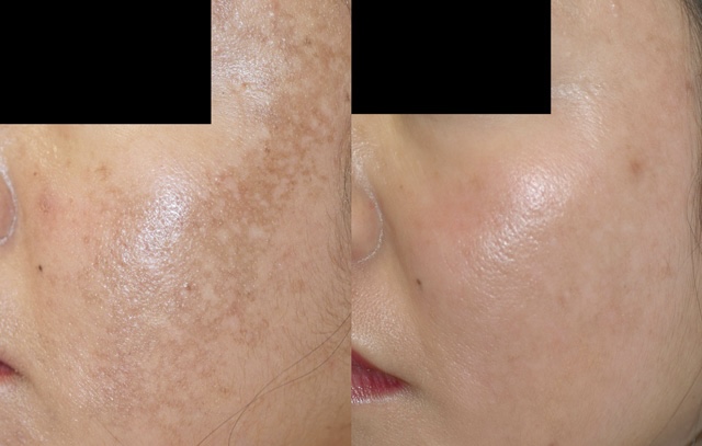 Before and after: sun spots and melasma transformation