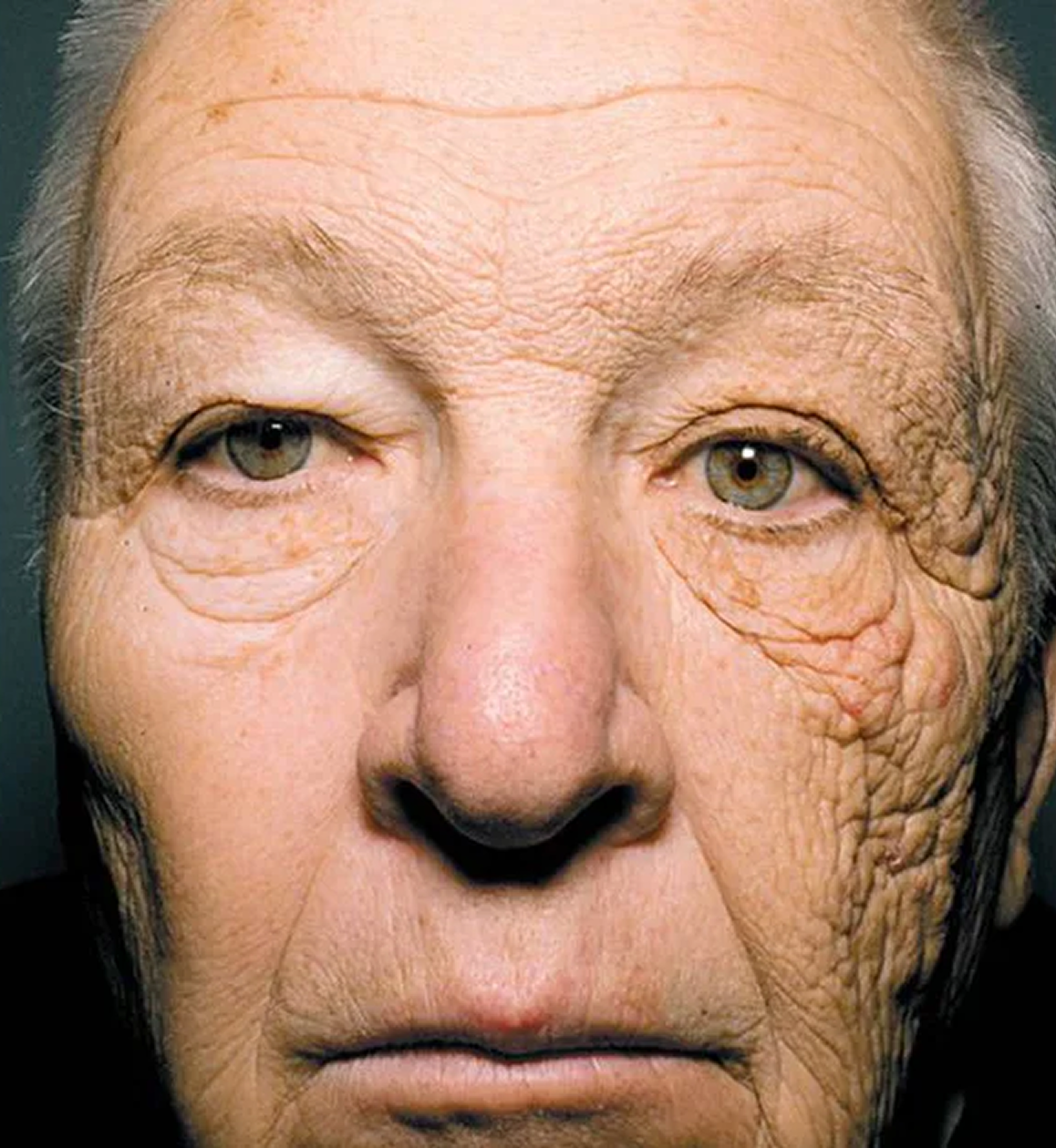 Truck driver with asymmetric facial aging from UV exposure