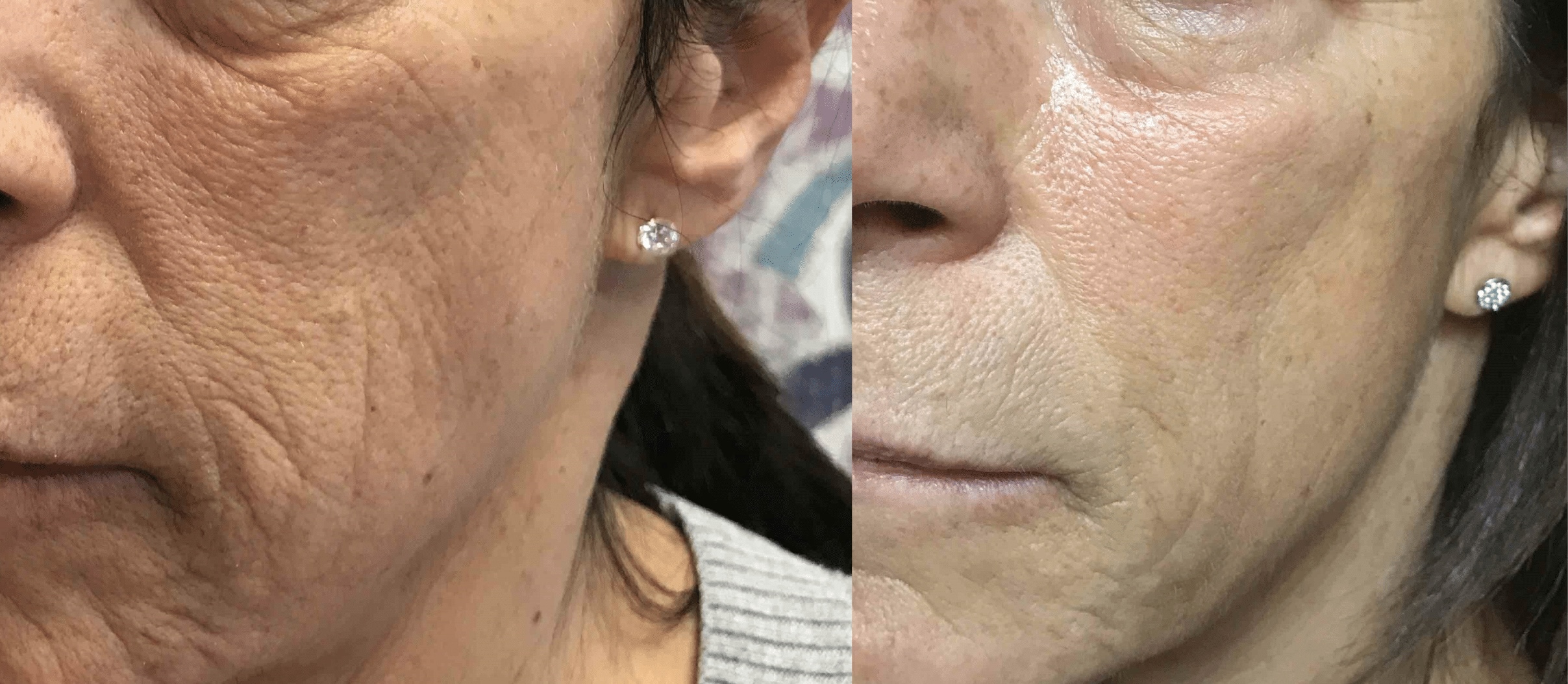Before and after: deep wrinkles and texture transformation
